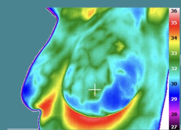 Breast thermography